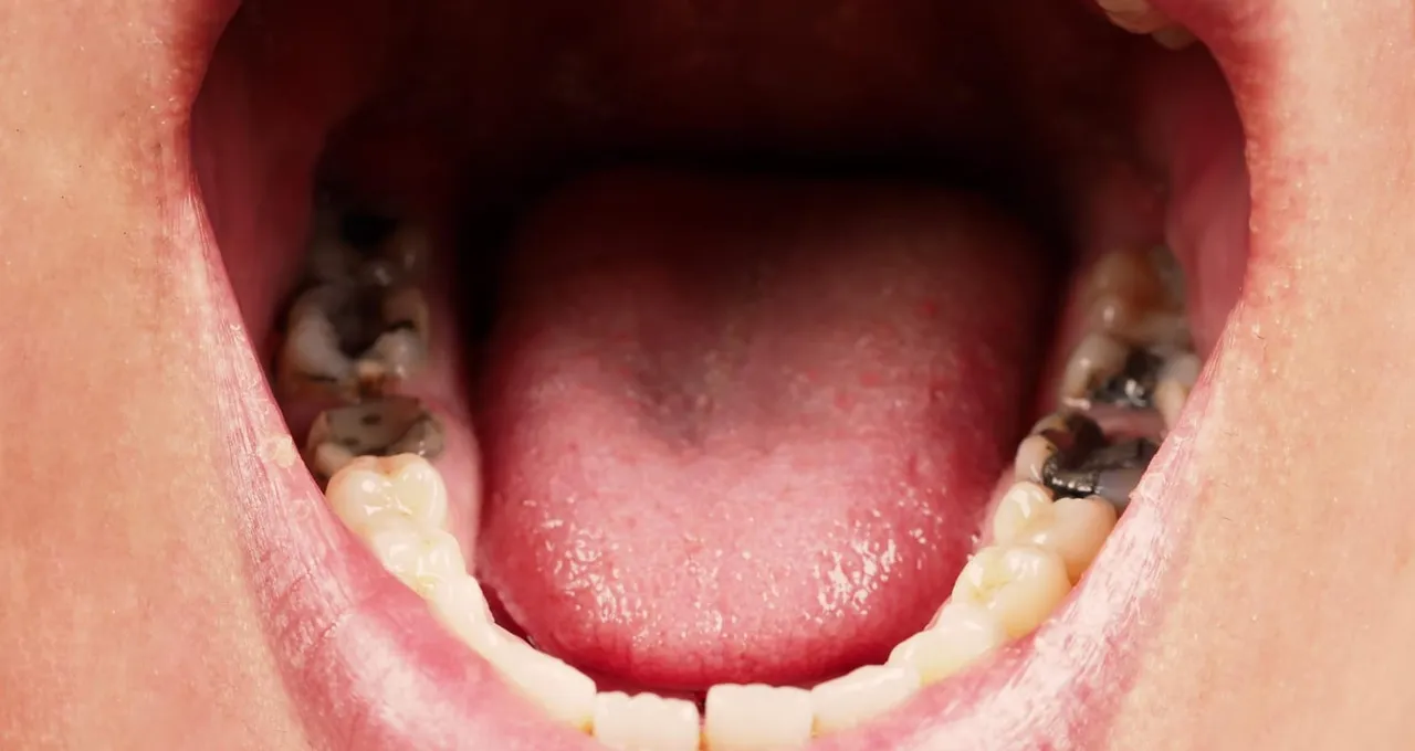 Pourquoi des dents pourrissent ?